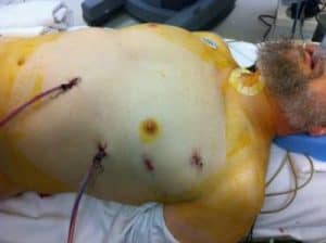 Incisions for totally endoscopy CABG__TECAB